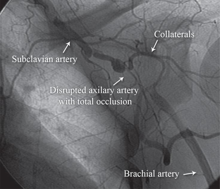 This diagnostic image is a pre-procedural digital subtraction angiography (DSA) of the left upper extremity, captured in an anteroposterior view. It illustrates critical vascular pathology following blunt trauma. The image demonstrates a continuous left subclavian artery that transitions into a severely disrupted axillary artery. There is a clear region of total occlusion in the axillary segment where the column of contrast agent abruptly terminates. To compensate for the lack of primary distal flow, multiple smaller, tortuous collateral vessels are visible, branching off the patent proximal segments in an attempt to perfuse the distal limb. The brachial artery is faintly visible distally, receiving minimal and delayed flow via these collateral pathways. This visual is used to teach the angiographic appearance of traumatic arterial dissection and complete vascular occlusion, highlighting the physiological development of collateral circulation in response to acute ischemic events in vascular surgery and interventional radiology.