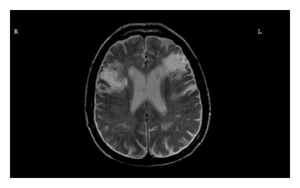 This diagnostic image is an axial T2-weighted magnetic resonance imaging (MRI) scan of the brain, specifically at the level of the lateral ventricles. The image demonstrates bilateral, slightly asymmetrical areas of high signal intensity (hyperintensities) located within the inferior frontal gyri (opercular regions). On the right side (labeled 'R'), the hyperintensity appears more irregular and prominent compared to the left side (labeled 'L'). These findings are consistent with chronic bilateral cortical infarcts involving the frontal opercula. The surrounding anatomy, including the ventricular system and posterior cortical structures, is visible, though the primary pathology is localized to the anterior cerebral parenchyma. This clinical imaging is educationally significant for illustrating the radiological presentation of chronic ischemic strokes and their potential association with clinical syndromes such as Foix-Chavany-Marie syndrome (anterior opercular syndrome), which presents with facio-glosso-pharyngo-masticatory diplegia.
