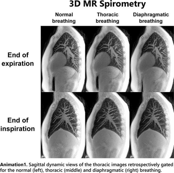 This diagnostic imaging panel presents six sagittal views of the human thorax obtained using 3D ultrashort echo time (UTE) Magnetic Resonance Imaging (MRI). The images compare three respiratory patterns: normal breathing (left), thoracic breathing (middle), and diaphragmatic breathing (right), captured at two distinct phases: end-expiration (top row) and end-inspiration (bottom row). Red overlay curves on the inspiration images mark the lung boundaries from the corresponding expiratory state to highlight anatomical displacement. Red arrows indicate the primary direction of motion, emphasizing diaphragmatic descent and anterior-posterior chest wall expansion. The 'normal' column shows a combination of diaphragmatic and thoracic movement, while 'thoracic' breathing exhibits more pronounced anterior chest wall protrusion, and 'diaphragmatic' breathing shows maximal inferior displacement of the diaphragm. This visualization is part of a 3D MR Spirometry study used to analyze respiratory mechanics, pulmonary dynamics, and regional volume expansion, demonstrating how different breathing maneuvers affect lung parenchyma motion and thoracic cavity volume.
