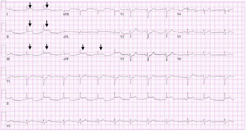 A standard 12-lead electrocardiogram (ECG) displayed on a pink grid background, illustrating acute myocardial changes in a clinical patient. The tracing shows a regular rhythm with discernible P waves and narrow QRS complexes. Significant pathology is highlighted by black arrows pointing to pronounced ST-segment elevations (STE) in the inferior limb leads (II, III, and aVF) and the lateral lead I. The morphology of the ST-segment elevation in these leads is convex (tombstoning) or upwardly sloped, merging with peaked T waves. Concomitantly, there are evident reciprocal ST-segment depressions (STD) in the precordial leads, specifically V1 through V4, where the ST segments exhibit a down-sloping morphology. The magnitude of elevation is most prominent in lead II. These findings are highly characteristic of an acute ST-elevation myocardial infarction (STEMI) pattern, which in this clinical context—associated with COVID-19 and elevated troponins—indicates severe myocardial injury or fulminant myocarditis mimicking an inferior-lateral infarction. The ECG serves as an educational example of identifying regional ST-segment changes and reciprocal patterns in cardiovascular emergency medicine.