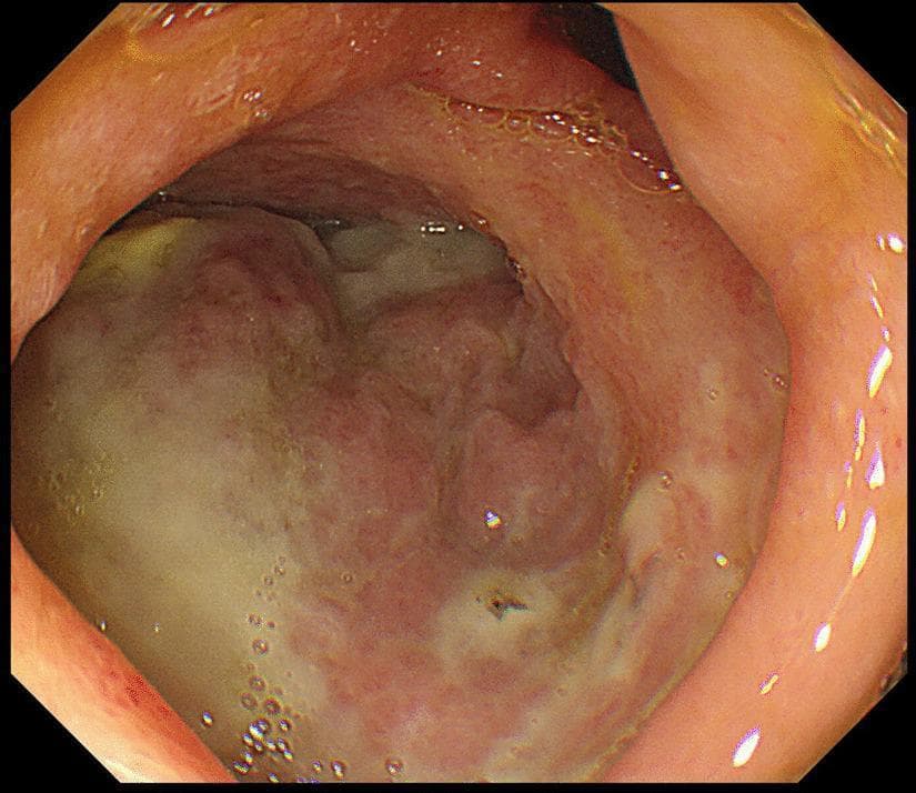 Gastrointestinal fiberscopy image of the duodenal bulb demonstrating a large, irregular ulcer on the posterior wall. The ulcer is characterized by a prominent white-to-yellowish fibrin base, consistent with an active stage (A1 according to the Sakita-Miwa classification). The lesion stands in sharp contrast to the surrounding duodenal mucosa, which appears erythematous and edematous with irregular contours and loss of normal mucosal texture. Visible clear fluid bubbles are scattered across the mucosal surface, likely representing gastric or duodenal secretions. The image illustrates a significant peptic ulcer in a clinical case complicated by perforation and subsequent intra-abdominal abscess formation. This visual is suitable for educational purposes regarding upper gastrointestinal endoscopy, peptic ulcer disease (PUD) morphology, and Sakita-Miwa staging.