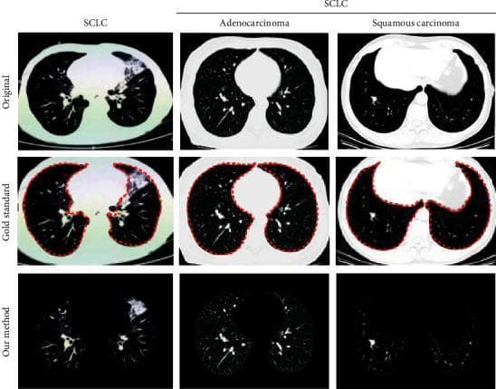 This diagnostic imaging set presents axial thoracic CT scans illustrating three types of lung cancer: Small Cell Lung Cancer (SCLC), Adenocarcinoma, and Squamous Cell Carcinoma. The content is organized into three comparative rows: 'Original' scans, 'Gold Standard' manual segmentations, and automated segmentation results ('Our method'). The SCLC image displays an irregular, large area of increased density in the upper right lung field, consistent with a consolidated mass. The adenocarcinoma scan reveals a more localized, peripheral rounded nodule in the left lung parenchyma. The squamous cell carcinoma scan shows a central lesion with significant soft tissue density near the mediastinum. The 'Gold Standard' row utilizes a red dotted contour to delineate the lung parenchyma boundaries, including the identified pathological regions. This comparison highlights the capability of deep learning algorithms in Lung Parenchyma Segmentation (LPS), specifically the extraction of texture features and nodule morphology for differential diagnosis between SCLC and Non-Small Cell Lung Cancer (NSCLC) subtypes in clinical oncology.