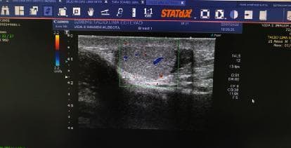 This diagnostic image is a scrotal ultrasound with Color Doppler of the left testicle. The grayscale (B-mode) imaging shows an oval-shaped testis with relatively homogeneous, isoechoic parenchymal echogenicity. The testicular capsule is clearly defined against the surrounding scrotal soft tissues. A Color Doppler sampling box is centered over the testicular parenchyma, demonstrating internal vascular flow represented by sparse red and blue signals, which indicate blood flow direction relative to the transducer. The user interface includes a vertical depth scale in centimeters on the left side of the scan window and a velocity color bar (set to 2.2 cm/s) for the Doppler settings. Textual annotations on the interface identify the anatomical region as 'TESTICULO ESQUERDO' (left testicle). This imaging modality is essential for evaluating testicular viability and perfusion in clinical scenarios such as suspected testicular torsion, orchitis, or scrotal trauma.