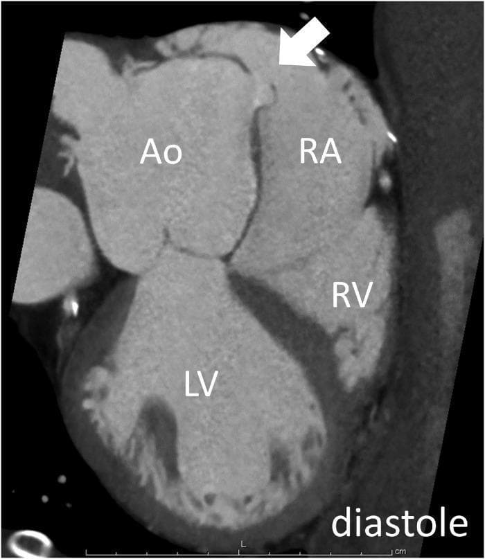 This diagnostic image is an electrocardiogram (ECG)-gated cardiac computed tomography (CCT) cine mode reconstruction captured during the diastolic phase of the cardiac cycle. The cross-sectional view displays the four major cardiac chambers and associated structures labeled as follows: Aorta (Ao), Right Atrium (RA), Right Ventricle (RV), and Left Ventricle (LV). A prominent white arrow indicates a flap-type rupture in the wall between the non-coronary cusp of the aorta and the right atrium. This visual evidence confirms a ruptured sinus of Valsalva aneurysm (SVA), showing an abnormal communication where the flap opens into the right atrium during diastole. The spatial arrangement shows the dilated aorta adjacent to a widened right atrium, with the right ventricle and thick-walled left ventricle positioned inferiorly. This image illustrates the pathophysiology of an intracardiac shunt causing a left-to-right flow, relevant for cardiologists and radiologists studying complex congenital or acquired structural heart defects and their presentation in cross-sectional imaging.