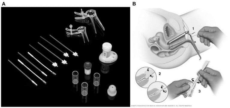 This composite educational graphic illustrates the tools and clinical technique for a Pap smear, a common screening procedure for cervical cancer. Figure A is a photograph of a Pap smear test kit containing various instruments on a black background: clear plastic vaginal speculums of different sizes, multiple cervical sampling devices including spatulas and endocervical brushes (cytobrushes), and liquid-based cytology collection vials. Figure B is a multi-step anatomical diagram showing the clinical procedure: (1) Cross-sectional view of a speculum inserted into the vagina to visualize the cervix, with a collection device entering the cervical canal; (2) Close-up insets showing the rotation of the cervical brush and spatula at the transformation zone to collect ectocervical and endocervical cells; and (3) The final step of transferring the collected cellular material into a preservative vial (liquid-based cytology) or onto a glass slide. The content is designed for medical training, highlighting essential gynecological screening equipment and correct sampling methodology.