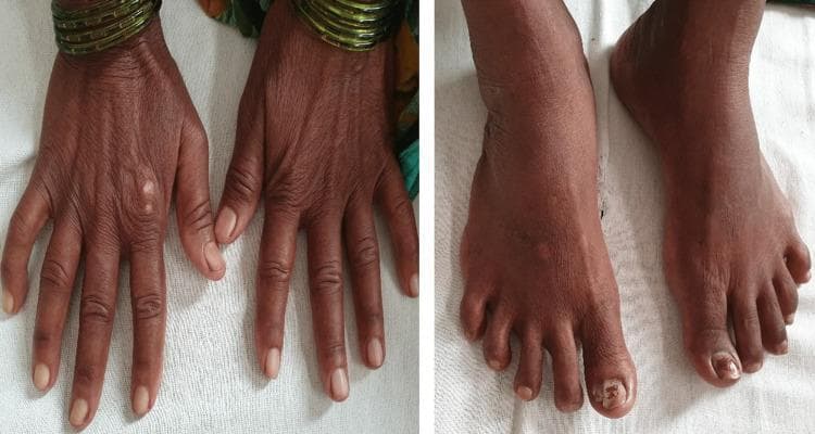 Two clinical photographs demonstrate dermatological manifestations of a systemic connective tissue disease, likely systemic sclerosis. The left panel shows the dorsal aspect of both hands, characterized by significant skin thickening and a taut, bound-down texture. The fingers exhibit tapering and fixed flexion contractures consistent with sclerodactyly. Subtle 'salt and pepper' pigmentary changes (hypopigmentation and hyperpigmentation) are visible on the dorsal surface. The right panel displays the dorsal aspect of the feet, which show similar skin tightening and thickening extending to the toes. Notable findings include xerosis (dryness) and onychodystrophy of the great toenails, suggestive of secondary fungal infection. These visual signs are classic hallmarks of the fibrotic phase of scleroderma, highlighting the loss of skin elasticity and characteristic digital changes used in the clinical diagnosis of CREST syndrome or systemic sclerosis.