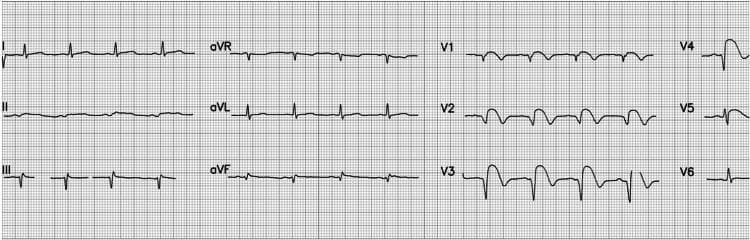 A 12-lead electrocardiogram (ECG) demonstrating an acute ST-elevation myocardial infarction (STEMI) with characteristic anterior and anterolateral findings. The tracing displays a normal sinus rhythm with a heart rate of approximately 84 beats per minute and normal P wave morphology. Significant pathology is localized to the precordial leads, specifically V2 through V5, which exhibit pronounced ST-segment elevation. This elevation presents with a convex 'tombstoning' morphology, a high-risk indicator of extensive myocardial injury. Additionally, evolving QS waves are visible in leads V2 and V3, indicating necrotic changes or transmural infarction. These findings are clinically consistent with an acute occlusion of the left anterior descending (LAD) coronary artery. The limb leads (I, II, III, aVR, aVL, aVF) show relatively stable baselines, though mild reciprocal changes or secondary ST-T wave abnormalities may be present in the inferior leads. This diagnostic image serves as a classic educational example of early-stage STEMI progression and the visual identification of localized ischemic injury on electrocardiography.