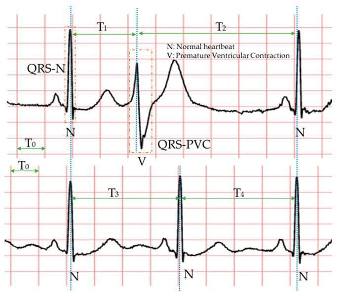 This diagnostic image provides a comparative electrocardiogram (ECG) analysis of a normal sinus rhythm versus a premature ventricular contraction (PVC). The top tracing illustrates a normal heartbeat (N) followed by a PVC (V). Key visual features include the morphology of the QRS-V complex, which is characterized by a broader duration and higher amplitude compared to the narrow, standard QRS-N complex. The PVC lacks a preceding P-wave and exhibits a discordant T-wave. Temporal markers compare the R-R intervals: T1 represents the shortened interval before the PVC (pre-prematurity), and T2 represents the subsequent compensatory pause. In the lower tracing of a regular sinus rhythm, T3 and T4 represent equal R-R intervals. The diagram highlights the clinical principle of a full compensatory pause, where T1 + T2 is approximately equal to T3 + T4. This educational graphic is designed to teach medical professionals the morphological and rhythmic identifiers used to diagnose ventricular arrhythmias, specifically focusing on QRS widening and interval disturbances.