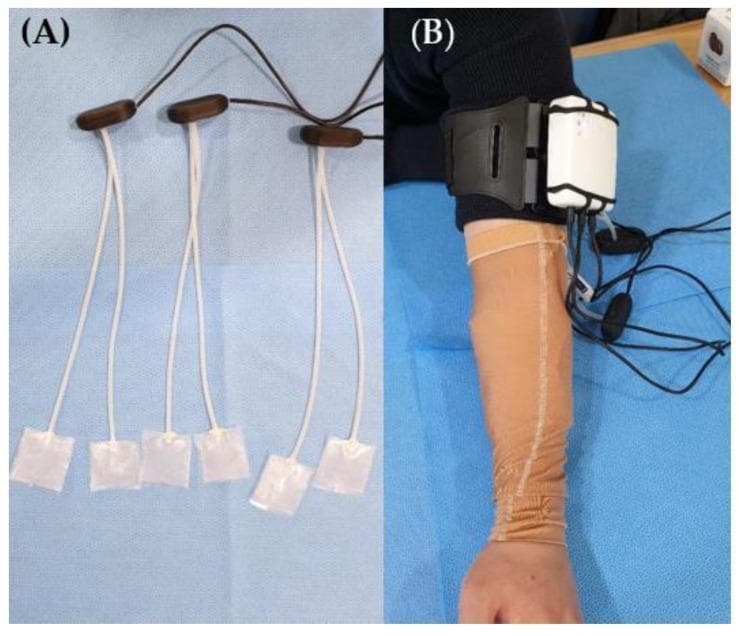 Clinical and procedural photographs illustrating a portable pressure-monitoring system used in burn scar management. Image (A) displays a detailed view of several flexible piezoresistive sensors. Each sensor consists of a square, translucent, ultra-thin pad connected by white leads to dark brown oblong hubs, which interface with a main data cable. Image (B) demonstrates the clinical application on a patient's forearm. The patient is wearing a tan-colored, tubular compression garment designed for hypertrophic scar therapy. A white, portable monitoring device is secured to the upper arm using a black adjustable strap. The sensors are placed at the interface between the compression garment and the skin to monitor the therapeutic pressure range, typically 15–25 mmHg. This setup is used in rehabilitative medicine to ensure consistent pressure application, which is critical for reducing scar thickness and improving skin elasticity during the proliferative phase of healing after burn injuries.