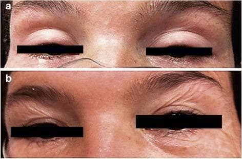 This clinical comparison photograph displays the periocular region of a patient before and after treatment for elapid envenomation. Panel (a) illustrates bilateral palpebral ptosis, a significant drooping of the upper eyelids that obscures much of the globe, which is a classic neurotoxic sign of Micrurus (coral snake) envenomation. The surrounding facial musculature appears paretic. Panel (b) shows the same patient after the administration of monovalent coral antivenom, demonstrating a total neurological recovery. Key visible changes in panel (b) include the restoration of the normal palpebral fissure width and the presence of dynamic skin wrinkling around the eyebrows, indicating active frontalis muscle contraction and the resolution of neurotoxic paralysis. This comparison serves as an educational tool for identifying the clinical presentation and therapeutic response of ophthalmic neurological deficits in snakebite victims.