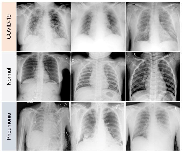 This diagnostic comparison chart presents a grid of nine posterior-anterior (PA) or anterior-posterior (AP) chest X-ray (CXR) images, categorized into three distinct clinical conditions: COVID-19, Normal, and Pneumonia. The top row, labeled 'COVID-19', demonstrates characteristic multifocal and bilateral ground-glass opacities (GGOs) with a predominantly peripheral and basal distribution. These hazy opacities obscure pulmonary vascular markings without completely concealing the underlying lung parenchyma. The middle row, labeled 'Normal', shows clear lung fields with sharp costophrenic angles, well-defined hemidiaphragms, and normal bronchovascular markings, serving as a baseline for anatomical comparison. The bottom row, labeled 'Pneumonia', illustrates varying degrees of pulmonary consolidation and dense opacification. Unlike the diffuse pattern often seen in the COVID-19 samples, these pneumonia images show more localized, dense lobar consolidations and air bronchograms. Some clinical images in this category also show medical interference like ECG leads and portable imaging markers. This comparison highlights key radiological features used in differential diagnosis, focusing on opacity distribution, density, and the presence of interstitial versus alveolar patterns.