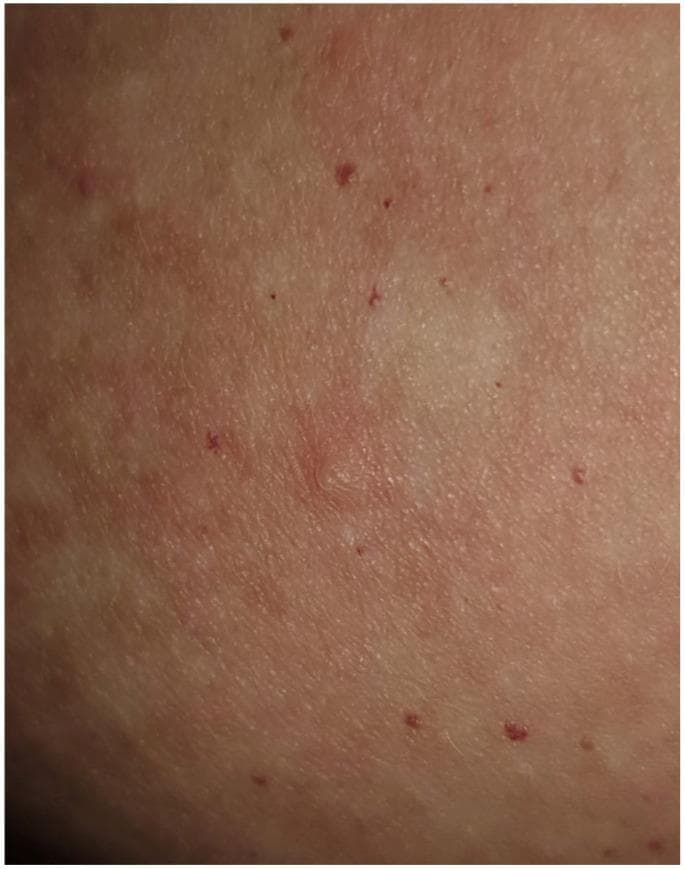 This clinical photograph shows a close-up view of the skin, likely from the trunk (seborrheic area), demonstrating characteristic features of an autoimmune bullous disease, specifically Pemphigus foliaceus. The primary finding is a small, superficial, flaccid blister (vesicle/bulla) located centrally. The lesion is pale and translucent compared to the surrounding skin, appearing thin-roofed and easily collapsible. The background skin is notably erythematous, with diffuse redness and scattered, tiny, punctate red papules or petechiae. The skin texture is irregular, indicating subtle edema and early epidermal involvement. This visual presentation illustrates acantholysis within the granular layer, a hallmark of superficial blistering disorders where bullae are transient and often rupture quickly to leave behind erosions and crusts. The image is a valuable educational resource for dermatology, focusing on the morphology of superficial bullous eruptions and their clinical distinction from deeper blistering conditions like pemphigus vulgaris or bullous pemphigoid.