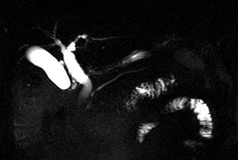 A Magnetic Resonance Cholangiopancreatography (MRCP) image providing a high-contrast visualization of the biliary tree and gallbladder. The image demonstrates high signal intensity (bright) fluid within the biliary system against a dark, suppressed background. Key anatomical features visible include the intrahepatic bile ducts, the gallbladder, and the extrahepatic biliary tree, including the common bile duct. The biliary tree appears patent with no evident filling defects or intraluminal obstructions, suggesting the absence of choledocholithiasis or strictures at the time of imaging. The common bile duct is noted to be approximately 12 mm in diameter, which may represent mild dilation depending on clinical history. The pancreatic duct is also partially visualized. This diagnostic image is used in gastroenterology and radiology to assess for biliary pathologies such as gallstones, bile duct dilation, or masses. The image highlights a post-symptomatic state where previous obstructions may have resolved.