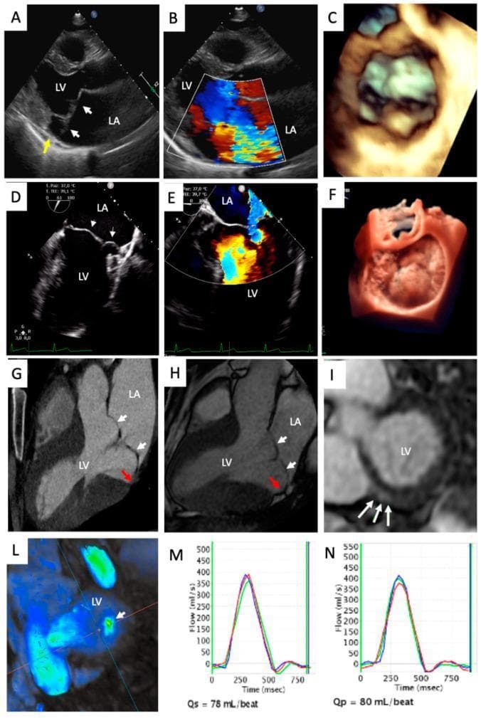 A multi-panel medical illustration demonstrating multimodality imaging of myxomatous mitral valve disease in a 37-year-old patient. Panels A, B, D, and E showcase Transthoracic (TTE) and Transesophageal Echocardiography (TEE), including parasternal long-axis (PLAX) and 4-chamber views. These images highlight bileaflet mitral valve prolapse (MVP), where leaflets (white arrows) are displaced superiorly into the left atrium (LA), accompanied by mitral annular disjunction (MAD, yellow arrow) and a centrovalvular mitral regurgitation jet on color Doppler. Panels C and F provide 3D-TTE and 3D-TEE reconstructions, visualizing the volumetric extent of the prolapse. Panels G and H represent Cardiac Computed Tomography (CCT) and Cardiac Magnetic Resonance (CMR) confirming bileaflet MVP and MAD (red arrows). Panel I (CMR Late Gadolinium Enhancement) reveals focal fibrosis in the left ventricle (LV) inferobasal wall. Panel L shows 4D-flow CMR visualizing the regurgitant jet, while panels M and N display phase-contrast flow measurements for aortic (Qs) and pulmonary (Qp) quantification. This composite facilitates comprehensive assessment of valvular morphology, regurgitation severity, and myocardial consequences.
