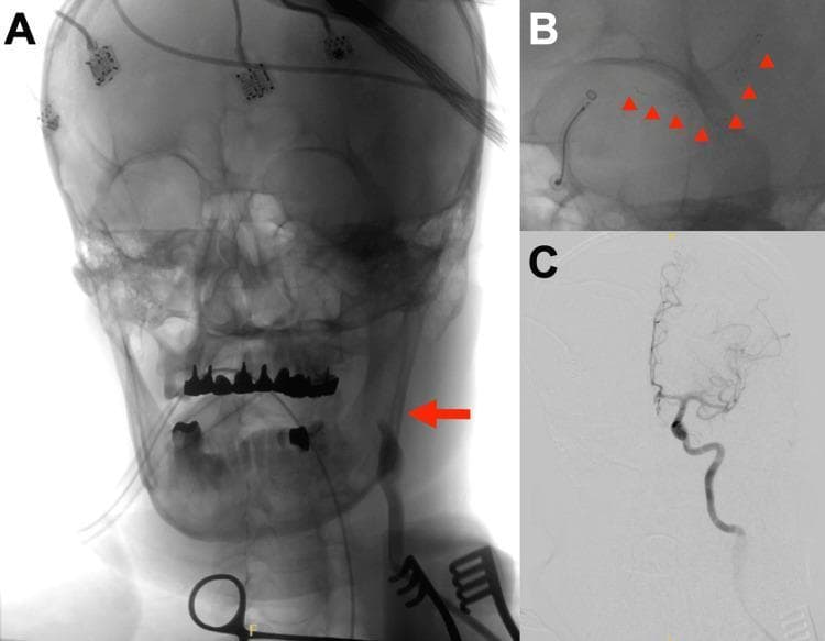 This composite figure illustrates a mechanical thrombectomy procedure for acute ischemic stroke using digital subtraction angiography (DSA) and fluoroscopic guidance. Panel A shows a frontal radiograph of the skull and neck during the initial phase. A red arrow indicates the site of a direct left common carotid artery (CCA) puncture. Visible external monitoring equipment includes multiple EEG electrodes adhered to the scalp and an endotracheal tube. Panel B provides a high-magnification fluoroscopic view of the neurointerventional procedure. Red arrowheads track the deployment of a stent retriever (Solitaire X) extending from the M2 segment of the middle cerebral artery to the terminal internal carotid artery (ICA), alongside a REACT71 aspiration catheter. Panel C presents a post-procedural DSA image demonstrating successful TICI 2b recanalization of the previously occluded left internal carotid artery and its distal branches. The content highlights advanced neurovascular rescue techniques and the specific approach of direct carotid access for mechanical thrombectomy in complex aortic anatomy.