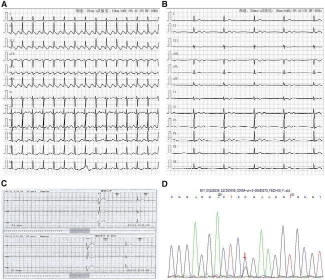 This composite diagnostic image illustrates cardiac electrophysiology findings and genetic analysis associated with Sick Sinus Syndrome (SSS). Panel A displays a 12-lead electrocardiogram (ECG) showing atrial flutter with a characteristic 'sawtooth' pattern of flutter waves (F-waves), most prominent in inferior leads, and a 2:1 conduction ratio resulting in a regular ventricular rate. Panel B shows a follow-up ECG demonstrating atrial standstill, characterized by the complete absence of P waves, and a slow, regular junctional escape rhythm. Panel C contains Holter monitoring strips exhibiting severe bradycardia and a prolonged sinus arrest with a maximum R-R interval of 7.96 seconds. Panel D provides a DNA sequencing chromatogram (Sanger sequencing) identifying a heterozygous SCN5A gene mutation (c.664C>G), which underlies the clinical presentation of familial SSS. The image serves as an educational resource for cardiology and medical genetics, linking phenotypic arrhythmia manifestations (atrial tachyarrhythmia followed by sinus arrest/atrial standstill) to a specific molecular genetic etiology.