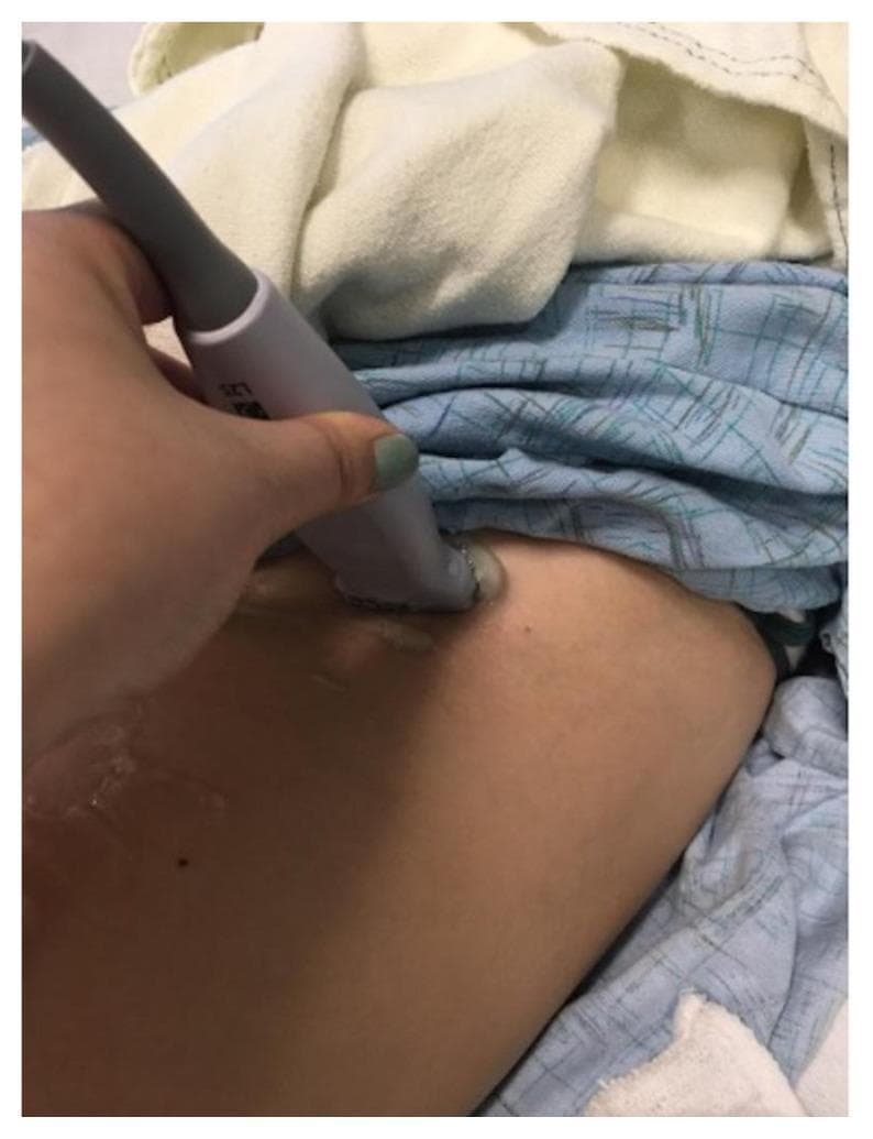 A clinical procedural photograph demonstrating the hand-eye coordination required for an ultrasound-guided femoral nerve block. The image shows a practitioner's hand holding a linear high-frequency ultrasound probe (labeled L7S) in a transverse orientation against the skin of the upper thigh/groin region. Clear acoustic coupling gel is visible at the interface between the rectangular probe head and the skin. The patient is draped with blue patterned and white linens, exposing the inguinal area for the procedure. This visual illustrates the initial positioning and transducer manipulation necessary to identify femoral anatomy, including the femoral artery, vein, and nerve, for regional anesthesia or emergency medicine residency training. The focus is on the correct grip and application of the probe to ensure optimal imaging of the femoral bundle before needle insertion.