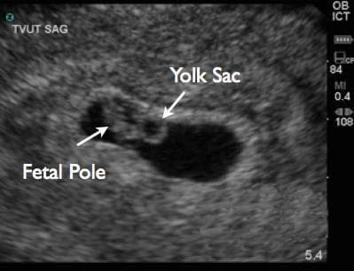 This diagnostic image is a grayscale transvaginal ultrasound (TVUS) in the sagittal plane, used for early pregnancy evaluation. It depicts a longitudinal view of a gestational sac, characterized as an anechoic (black) fluid-filled cavity within the echogenic uterine decidua. Within the gestational sac, two primary embryological structures are identified with white arrows and labels: the 'Fetal Pole' and the 'Yolk Sac'. The fetal pole appears as a small, elongated echogenic structure, representing the developing embryo. Adjacent to it, the yolk sac is visible as a distinct, circular, hyperechoic ring with an anechoic center. Technical overlays indicate the imaging modality ('TVUT SAG'), transducer type ('ICT' for intracavitary), and machine parameters (MI 0.4, PRF 84). The image provides clinical evidence of a viable intrauterine pregnancy, demonstrating the presence and spatial relationship of the yolk sac and embryo, which are critical for dating and assessing early developmental milestones.