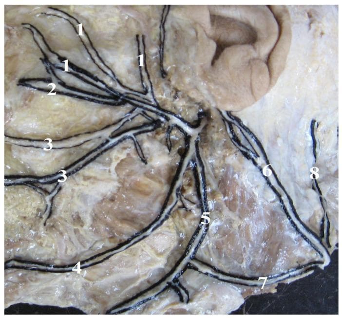 An anatomical dissection photograph illustrating the terminal branching patterns of the human facial nerve (CN VII) and its cervical connections. The image displays a 'Type I' branching variant characterized by a fan-like distribution over the facial musculature. Key structures labeled include the temporal branches (1) extending superiorly, zygomatic branches (2) coursing toward the midface, and buccal branches (3) distributed across the cheek area. Inferiorly, the marginal mandibular branch (4) follows the lower border of the mandible, while the cervical branch (5) descends toward the neck. The dissection also highlights the greater auricular nerve (6) and the lesser occipital nerve (8). Of clinical and surgical significance is the depicted connection (7) between the cervical branch of the facial nerve and the transverse cervical nerve of the cervical plexus. This anatomical resource serves to educate on neuroanatomical variations relevant to parotid surgery, facial reconstruction, and local anesthesia.
