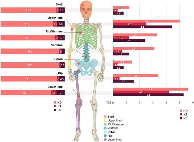 A multi-panel medical infographic illustrating the relationship between fracture anatomical sites and kidney replacement therapy (KRT) modalities: Hemodialysis (HD), Kidney Transplant (KT), and Peritoneal Dialysis (PD). The central element is a color-coded human skeletal diagram highlighting seven anatomical regions: skull, upper limb, rib/sternum, vertebra, pelvis, hip, and lower limb. The left panel features horizontal stacked bar charts showing the proportion (%) of each KRT modality within specific fracture cohorts, demonstrating that HD patients consistently comprise the vast majority (approx. 88-95%) of patients at every fracture site. The right panel displays clustered horizontal bar graphs showing the frequency (%) of fractures at each site stratified by modality. This data indicates that the HD group has the highest fracture frequency across all sites compared to PD and KT, with the upper and lower limbs being the most frequent sites of injury. This comparison chart serves as a clinical epidemiology resource for understanding bone mineral disorders and fracture risk in end-stage kidney disease (ESKD) populations.