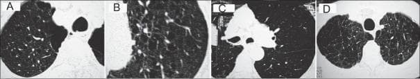 This diagnostic image consists of four high-resolution computed tomography (HRCT) axial sections of the lung parenchyma, illustrating the primary radiological patterns of emphysema in Chronic Obstructive Pulmonary Disease (COPD). Images A and B demonstrate centriacinar emphysema, characterized by small, focal areas of low attenuation (lucent airspaces) located in the center of the secondary pulmonary lobules, typically surrounding the central bronchovascular bundle. Image C displays panacinar emphysema, showing a more uniform and diffuse destruction of the entire acinus, resulting in generalized lung hyperlucency and attenuation of the pulmonary vasculature. Image D illustrates paraseptal emphysema (distal acinar emphysema), where focal lucent airspaces are distributed preferentially along the subpleural surfaces and interlobular septa, often demarcated by thin walls. Key educational concepts include the distinction between lobular distributions and the resulting architectural distortion and vascular attenuation associated with progressive alveolar wall destruction.