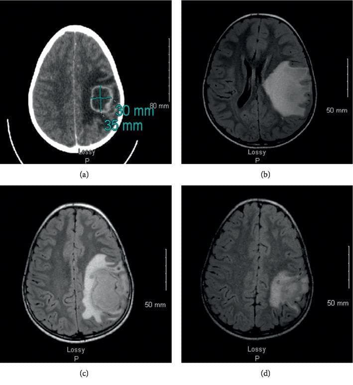 Educational clinical imaging composite illustrating the progression and management of a brain abscess in a pediatric patient. Panel (a) shows an axial non-contrast CT scan of the brain, revealing a hypodense lesion with peripheral rim enhancement in the left frontoparietal region, measured at 30 x 35 mm, consistent with an abscess. Panels (b), (c), and (d) provide a longitudinal MRI series in axial orientation (FLAIR or T2-weighted sequences) tracking the lesion's evolution. Panel (b) at T0 shows a high-signal intensity lesion in the left frontotemporal lobe with significant vasogenic edema and midline shift. Panel (c) at T+23 days demonstrates an interval increase in abscess volume and mass effect, providing visual justification for repeat neurosurgical drainage. Panel (d) at T+2 months displays a marked reduction in lesion size, resolution of midline shift, and decreased perilesional edema following targeted antibiotic therapy and surgical intervention. Scale bars (80 mm for CT and 50 mm for MRI) are included for quantitative reference. This series highlights the importance of serial neuroimaging in monitoring intracranial infections and evaluating treatment efficacy.