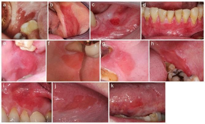 This composite of clinical intraoral photographs (labeled a–k) demonstrates various presentations of oral erythroplakia (OE) across eleven patients. The primary anatomical sites shown include the buccal mucosa, alveolar ridge, and gingiva. The lesions are characterized by persistent, well-demarcated, fiery red macules or patches. Morphologically, the majority of the lesions (e.g., a, b, d, i, j, k) exhibit a uniformly erythematous appearance, while others (e.g., e, g, h) present with minor, interspersed white areas (speckled erythroplakia). All depicted lesions feature a smooth, non-granular surface texture, ranging from matte to shiny. Most OEs show sharp, well-defined borders distinguishing them from the surrounding healthy mucosa, which is a critical diagnostic feature to differentiate them from non-specific inflammatory erythema. Clinically, these images illustrate a high-risk oral potentially malignant disorder (OPMD), highlighting the importance of visual screening for well-defined red patches that lack a clear reactive or inflammatory etiology.