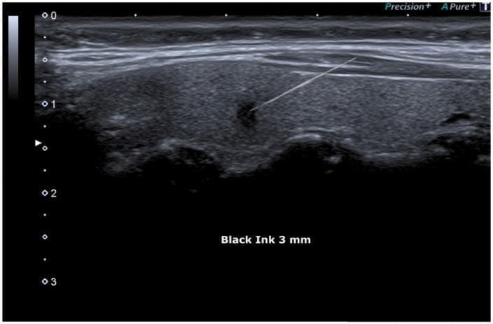 A diagnostic ultrasound image of the thyroid gland demonstrating an ultrasound-guided fine needle aspiration cytology (FNAC) procedure. The image reveals a large, predominantly isoechoic to mildly heterogeneous parenchymal mass containing a distinct, small, focal hypoechoic micro-focus. A highly echogenic, thin linear structure representing a biopsy needle is visualized in a diagonal orientation, entering from the upper right. The distal tip of the needle is precisely positioned within the center of the dark hypoechoic lesion. Superficial to the target mass, anatomical layers of subcutaneous tissue and muscle are visible as striated, horizontal echogenic bands. Depth markers are present on the left axis, and the annotation 'Black Ink 3 mm' likely refers to the size of the micro-focus or marking for surgical orientation. This image illustrates the real-time clinical application of ultrasonography in identifying and sampling suspicious thyroid nodules, specifically those suggestive of papillary thyroid carcinoma (TIR5/Bethesda VI).
