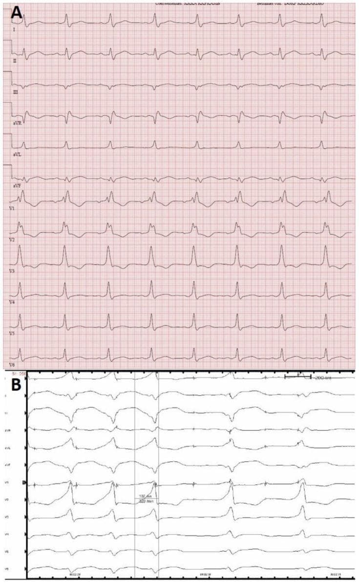 Two-part comparison of 12-lead electrocardiogram (ECG) tracings from a patient diagnosed with a left posterolateral accessory pathway (AP), illustrating Wolff-Parkinson-White (WPW) syndrome features. Panel A displays a standard resting ECG at a sweep speed of 50 mm/s. It exhibits manifest ventricular preexcitation characterized by short PR intervals and prominent delta waves, particularly visible in the precordial leads. Panel B shows an ECG recorded during an electrophysiology study (EPS) under rapid atrial pacing at a sweep speed of 100 mm/s. This maneuver induces full ventricular preexcitation, resulting in maximally widened QRS complexes and exaggerated delta wave morphology. The tracing demonstrates morphology shifts in the R/S ratios and QRS polarity, particularly in leads III, aVF, and V1-V2, which are diagnostic indicators used for the anatomical localization of the accessory pathway. The comparison highlights how pacing can accentuate preexcitation patterns for clinical assessment.