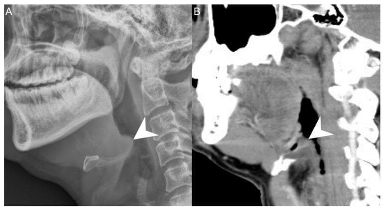 This dual-panel diagnostic image compares a lateral neck radiograph (A) with a sagittal computed tomography (CT) scan (B) of a patient with acute epiglottitis. In panel A, the lateral X-ray demonstrates a classic 'thumbprint sign,' where the arrowhead indicates a severely swollen, radiopaque epiglottis protruding into the airway. The surrounding soft tissues show decreased clarity compared to the dense cervical vertebrae. Panel B provides a sagittal CT reconstruction of the same anatomical region, offering superior soft tissue contrast and spatial resolution. The arrowhead in the CT scan highlights the thickened, edematous epiglottis and aryepiglottic folds, which significantly narrow the laryngeal inlet. The CT modality also better delineates the surrounding deep neck spaces, aiding in the assessment of concurrent deep neck infections. These images serve as a clinical comparison of imaging modalities used in diagnosing upper airway emergencies and illustrating the pathological morphology of epiglottic inflammation.