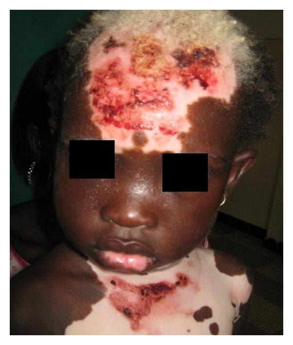Clinical photograph of a pediatric patient with generalized vitiligo and secondary skin changes. The image displays extensive, sharply demarcated patches of depigmentation (achromia) on the forehead, chest, and lower lip, contrasting with the patient's natural dark skin tone. Notable leukotrichia (depigmented hair) is visible on the scalp. Within the larger depigmented macules on the forehead and upper chest, there are superimposed erythematous erosions, hemorrhagic crusting, and dark brown scabs, likely representing secondary cutaneous damage, such as actinic injury or superinfection in the unprotected amelanotic skin. The distribution is multi-focal, involving the face and trunk. This case illustrates the clinical presentation of early-onset vitiligo and the vulnerability of depigmented skin to environmental or secondary factors in a young child with a family history of the condition.