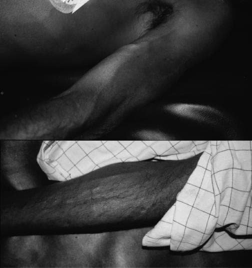 Two black-and-white clinical photographs showing peripheral vasodilatation in patients with distributive shock. The top image displays a supine patient (BP 85/35 mmHg) with prominent, distended superficial veins across the upper arm and chest wall. The bottom image shows a second patient (BP 55/30 mmHg) with similar marked venous engorgement in the forearm, with superficial veins appearing highly visible and distended despite severe systemic hypotension. These visual findings demonstrate the paradoxical clinical presentation of distributive shock—often seen in severe organophosphate poisoning—where pathological peripheral vasodilation occurs instead of the expected compensatory vasoconstriction typical of hypovolemic or cardiogenic shock. Key concepts illustrated include the assessment of peripheral vascular tone, venous distension, and the recognition of warm shock/low systemic vascular resistance in an emergency clinical setting.