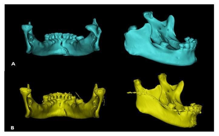 This diagnostic image displays 3D reconstructions of a human mandible from two perspectives, illustrating pre-operative and post-operative states of a subcondylar fracture. Panel A (cyan) shows the pre-operative state, where a subcondylar fracture has caused inward collapse and medial displacement of the condylar head, resulting in mandibular asymmetry and dental malocclusion. Panel B (yellow) demonstrates the post-operative results following surgical reduction and internal fixation. In this view, the condylar head is restored to its anatomical position atop the mandibular ramus. A surgical fixation plate is visible along the lateral aspect of the ramus, stabilizing the fracture site. The dental arches show improved alignment and symmetry compared to the pre-operative state. These reconstructions, likely generated using Mimics software from CT data, serve as an educational tool for maxillofacial surgery, specifically highlighting the management of condylar fractures and the use of trapezium plates for osteosynthesis.