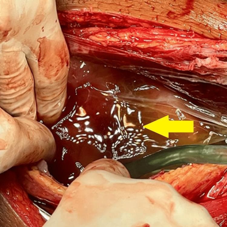 This intraoperative clinical photograph captures an exploratory laparotomy, a common surgical procedure for abdominal evaluation. The image displays an open surgical field characterized by a midline incision, revealing subcutaneous adipose tissue and skeletal muscle layers. A significant amount of translucent, amber-colored peritoneal fluid (ascites) is pooled within the abdominal cavity, as indicated by a yellow arrow. The fluid exhibits a glistening, reflective surface under the surgical lighting. To the left, gloved hands are visible, retracting the abdominal wall to facilitate visualization of the internal structures. A suction catheter or medical tube is positioned within the field, likely for the drainage of the ascitic fluid. The surrounding tissues appear erythematous and inflamed, which is consistent with the clinical context of suspected malignancy or advanced intra-abdominal pathology. This photograph serves as an educational tool for identifying ascites during surgical exploration and understanding the gross anatomical appearance of the peritoneal cavity in complex gynecological or oncological cases.