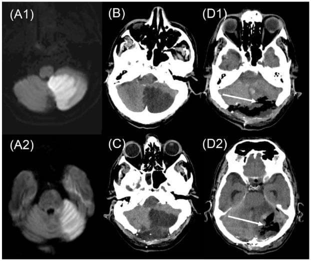 This composite diagnostic image illustrates the radiological progression and surgical management of a multilevel posterior circulation stroke in a 46-year-old patient. Panels A1 and A2 are axial diffusion-weighted MRI (DWI) scans showing hyperintense signals in the left inferior and superior cerebellar hemispheres, diagnostic of acute extensive cerebellar infarction following basilar artery occlusion. Panels B through D2 present a timeline of axial CT scans focusing on the posterior fossa. Image (B) shows early cerebellar edema with mass effect. Image (C) demonstrates the patient status post a 5 cm decompressive posterior craniectomy, though persistent mass effect on the brainstem remains evident. Images (D1) and (D2) show the outcome following a secondary surgery on day 3, featuring an enlarged 7 cm craniectomy and partial resection of infarcted cerebellar tissue (indicated by white arrows). The series demonstrates the evolution of space-occupying cerebellar infarction and the neurosurgical interventions—decompressive craniectomy and strokeectomy—used to mitigate life-threatening mass effect and brainstem compression.