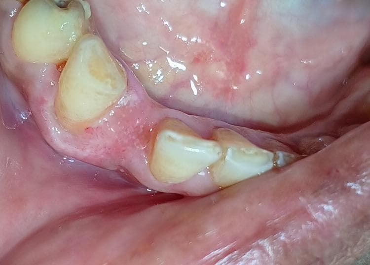 This intraoral clinical photograph shows a postoperative view of the mandibular right anterior region, specifically focusing on the gingiva surrounding the lateral incisor and canine. The image demonstrates a three-month follow-up after the surgical excision of a pyogenic granuloma. The gingival tissue appears healthy, exhibiting a normal pale pink color and firm texture with no signs of edema, erythema, or residual swelling. The interdental papillae are intact, and the surgical site shows complete secondary intention healing without visible scar tissue or recurrence of the pedunculated lesion. The adjacent teeth show yellowish physiologic staining. This image serves as an educational example of successful periodontal soft tissue healing and the clinical appearance of healthy gingiva following electrosurgical intervention.