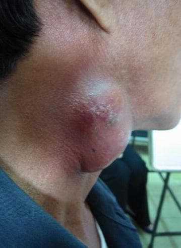 A clinical photograph of the lateral neck region of a patient, demonstrating a large, protruding mass consistent with cervical lymphadenopathy. The swelling is approximately 5-7 cm in diameter, exhibiting a lobulated and rounded morphology. The overlying skin shows significant pathological changes, including intense erythema (redness), localized edema that gives the surface a shiny and stretched appearance, and areas of focal ulceration or crusting suggestive of an impending or active fistula formation (scrofuloderma). The visual presentation illustrates paradoxical tuberculosis-associated immune reconstitution inflammatory syndrome (TB-IRIS), where existing lymph node lesions worsen after the initiation of antiretroviral therapy (ART) in HIV-infected individuals. Key educational features include the signs of acute inflammation and tissue breakdown in the context of chronic infectious lymphadenitis.