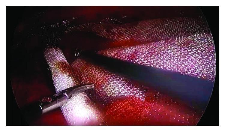 This clinical photograph captures a laparoscopic view during an e-TEP (enhanced-view Totally Extraperitoneal) Rives-Stoppa ventral hernia repair. The image demonstrates the placement and unrolling of a silver-white polypropylene mesh in the retrorectus (retromuscular) space. The mesh exhibits a characteristic woven or knitted grid-like texture with uniform micropores and visible filaments, displaying inherent flexibility as it drapes over the underlying tissues. A metallic laparoscopic grasper is visible in the lower-left foreground, manipulating the mesh. The surgical field reveals reddish, vascularized muscle tissue with a moist, glossy appearance. Shadowing at the center suggests the use of laparoscopic instrumentation within a confined preperitoneal plane. This visual illustrates a critical step in modern abdominal wall reconstruction, emphasizing the importance of proper mesh orientation and wide overlap within the retrorectal space to prevent hernia recurrence.