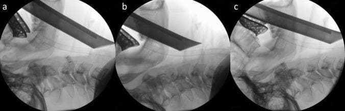 A series of three lateral intra-operative X-ray radiographs (labeled a, b, and c) demonstrating the anatomical alignment of the head and neck during tracheal intubation in three distinct positions: (a) sniffing position, (b) simple head extension, and (c) hyperextension. Each image shows a radiopaque Macintosh laryngoscope blade inserted into the oropharynx, with the tip situated in the vallecula to elevate the epiglottis. An endotracheal tube is visible passing through the larynx into the trachea. The radiographs illustrate the varying maxillopharyngeal angles and the relative spatial relationships between the cervical spine (C1-C7), mandible, hyoid bone, and laryngeal structures. In position (a), the characteristic 'sniffing' posture shows flexion of the lower cervical spine and extension at the atlanto-occipital joint. Positions (b) and (c) show progressive degrees of global cervical extension. This comparison is used in anesthesiology to evaluate the optimization of the laryngeal view and ease of intubation based on patient positioning.