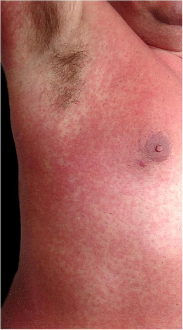 A clinical photograph showing a close-up of a patient's trunk and right axillary region on the third day of a rubelliform rash evolution. The image depicts a dense, generalized exanthem characterized by numerous small, erythematous maculopapular lesions. The morphology shows discrete reddish papules that are closely spaced, forming a nearly confluent, morbilliform-like pattern over the chest and abdomen. A distinctive clinical feature in this view is the relative sparing of the right axillary region, where the skin appears significantly less affected compared to the surrounding intensely red areas. The nipple and areola are visible and appear unaffected. The presentation is characteristic of an infectious viral exanthem, which in this clinical context was confirmed as a secondary dengue virus infection. The visual focus is on the morphology and distribution of the rash, providing an educational example of how systemic viral infections can manifest cutaneous signs while sparing certain anatomical regions.