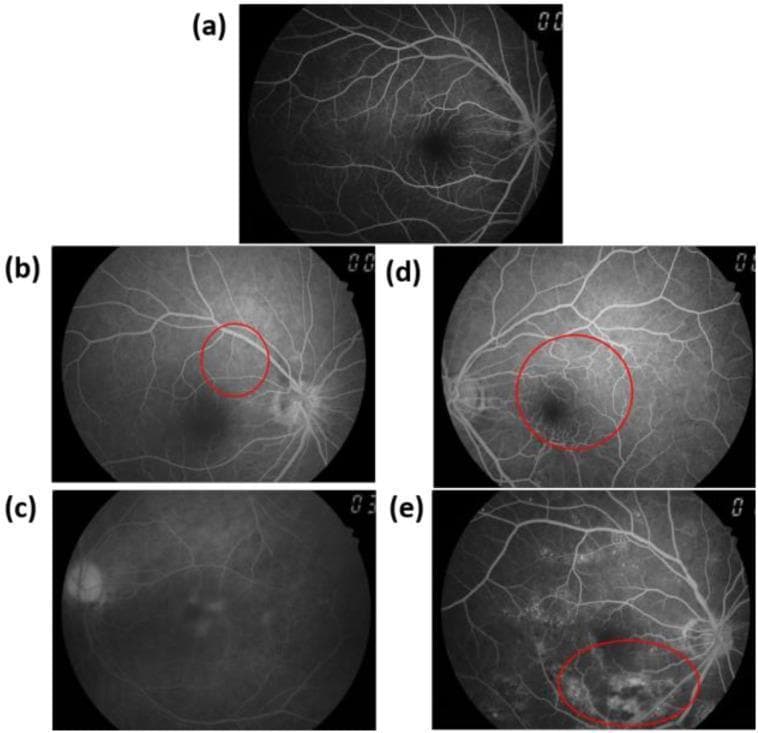 This diagnostic image set consists of five fundus fluorescein angiography (FA) images (a–e) demonstrating the progression of diabetic retinopathy (DR). (a) Normal: Displays a healthy retinal vascular pattern with a clear macula and well-defined optic disc. (b) Background Diabetic Retinopathy (BDR): Highlights early microvascular changes, with a red circle indicating hyperfluorescent microaneurysms. (c) Pre-proliferative Diabetic Retinopathy (PPDR): Shows significant capillary non-perfusion, characterized by extensive areas of hypofluorescence (dark zones) where microvessels have dropped out. (d) Early Proliferative Diabetic Retinopathy (PDR): Features early neovascularization, with a red circle highlighting tufts of hypervascularization on the retina or disc. (e) Late PDR: Demonstrates advanced disease where active leakage from fragile new vascular tissue causes diffuse, high-intensity hyperfluorescent staining (indicated by a red circle). The series illustrates key pathological markers used in ophthalmology for staging DR, including microangiomas, ischemia, and neovascularization, emphasizing the clinical significance of FA in identifying vascular leakage and non-perfusion.
