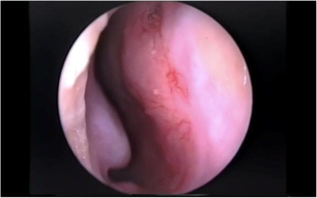 This clinical endoscopic photograph captures the internal anatomy of the nasal cavity, specifically focusing on the anterior nasal septum. The image illustrates the 'Little's area,' which houses the Kiesselbach's plexus, a highly vascularized region where the sphenopalatine, greater palatine, superior labial, and anterior ethmoidal arteries anastomose. The septal mucosa appears pinkish-red and moist. Visible on the surface is a network of fine, branching, and interconnected superficial red blood vessels (telangiectasia). The density of these vessels in this specific anatomical location is the primary clinical source for approximately 80% of anterior epistaxis cases. The image demonstrates the characteristic vascular fragility of this region, which is susceptible to environmental dryness, digital trauma, and inflammation. This visual is intended for ENT specialists and emergency medicine providers to understand the pathophysiology of nosebleeds and identify potential sites for chemical cauterization or topical treatment.