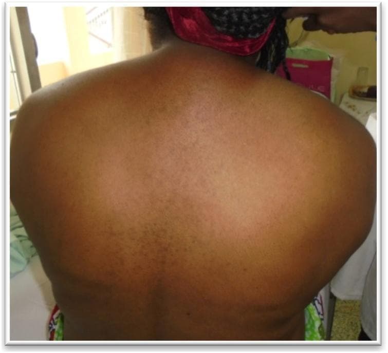 A clinical photograph of the posterior aspect of a patient's upper back and neck region, demonstrating a 'buffalo hump' (dorsocervical fat pad). The image shows a prominent, localized accumulation of subcutaneous adipose tissue in the upper thoracic and lower cervical region, creating a rounded, convex deformity between the shoulder blades and at the base of the neck. The skin overlying the fat pad appears stretched but otherwise intact, with subtle hyperpigmentation and scattered small macules. This physical finding is a classic clinical manifestation of hypercortisolism (Cushing's syndrome), characterized by centripetal fat redistribution. The photograph is taken from a posterior-superior perspective, highlighting the anatomical prominence relative to the scapulae and spine, which is useful for medical students and clinicians in identifying physical signs of endocrine dysfunction.