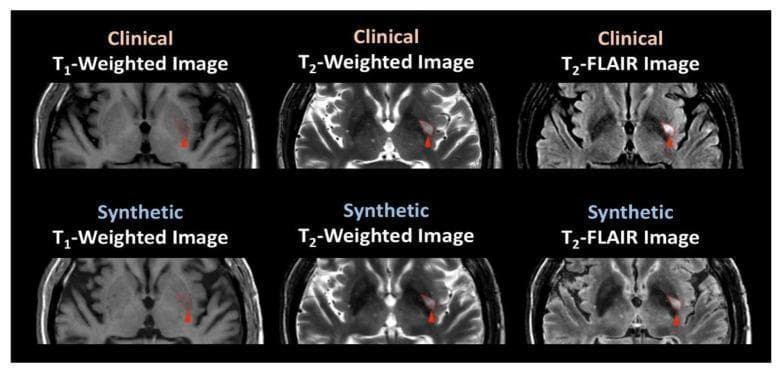 A comparison chart of axial brain Magnetic Resonance Imaging (MRI) scans from a 64-year-old male patient with an ischemic stroke. The image displays a 2x3 grid comparing clinical MRI acquisitions (top row) with synthetically generated counterparts (bottom row). Three distinct pulse sequences are shown: T1-weighted, T2-weighted, and T2-FLAIR. An acute/subacute stroke lesion is identified in the right basal ganglia/thalamic region, marked by red arrowheads across all views. In both clinical and synthetic T1-weighted images, the lesion appears hypointense relative to the surrounding brain parenchyma. In the T2-weighted and T2-FLAIR sequences, the lesion exhibits a clear hyperintense signal. The synthetic images demonstrate high fidelity in replicating the contrast, lesion morphology, and anatomical detail of the clinical scans, including the suppression of cerebrospinal fluid signal in the FLAIR images. This diagnostic comparison highlights the utility of synthetic MRI in identifying cerebrovascular pathology and its clinical equivalence to standard imaging modalities in neuro-radiology.