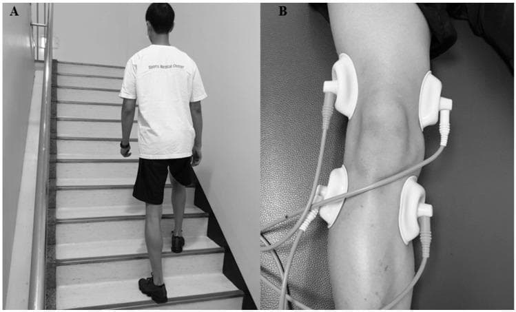 This composite clinical figure demonstrates therapeutic interventions for knee osteoarthritis rehabilitation. Panel A is a clinical photograph of a patient performing stair-climbing training in a controlled indoor environment. The patient is viewed from the posterior aspect, ascending a staircase equipped with a handrail. This exercise focuses on functional mobility and strengthening the quadriceps and hamstring muscles. Panel B is a procedural image showing the application of Interferential Electrotherapy (IFE) to the knee joint. Four circular suction-type electrodes are arranged symmetrically around the patella—two placed proximally on the distal thigh and two placed distally on the proximal calf. The electrodes are connected via cables to an external interferential current (IFC) device. The setup illustrates a multimodal physiotherapy approach combining active exercise with electrotherapy to manage pain and improve postural stability in geriatric patients with knee osteoarthritis.