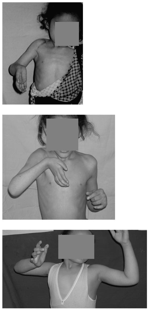 This sequence of three clinical photographs documents the longitudinal outcomes of reconstructive nerve surgery (neurotization) for late-presentation brachial plexus injuries in pediatric patients. The images illustrate the progression of upper limb function and joint alignment over a four-year period. Initial frames show a patient with classic signs of C5-T1 nerve root involvement, including a severe supination deformity of the forearm, wrist extension deformity, and shoulder weakness characterized by biceps co-contraction during attempted abduction. Middle and final frames demonstrate varying degrees of recovery in the deltoid and infraspinatus muscles, leading to improved active shoulder abduction and some restoration of forearm pronation. The visual data highlights the clinical significance of nerve augmentation for improving muscle power in the biceps, deltoids, and wrist extensors, while also tracking the mitigation of pathological co-contractions. This case study serves as an educational reference for orthopedic and neurological specialists evaluating the efficacy of phrenic-to-suprascapular and contralateral C7 neurotization techniques in pediatric brachial plexus birth palsy (BPBP) or traumatic injury management.