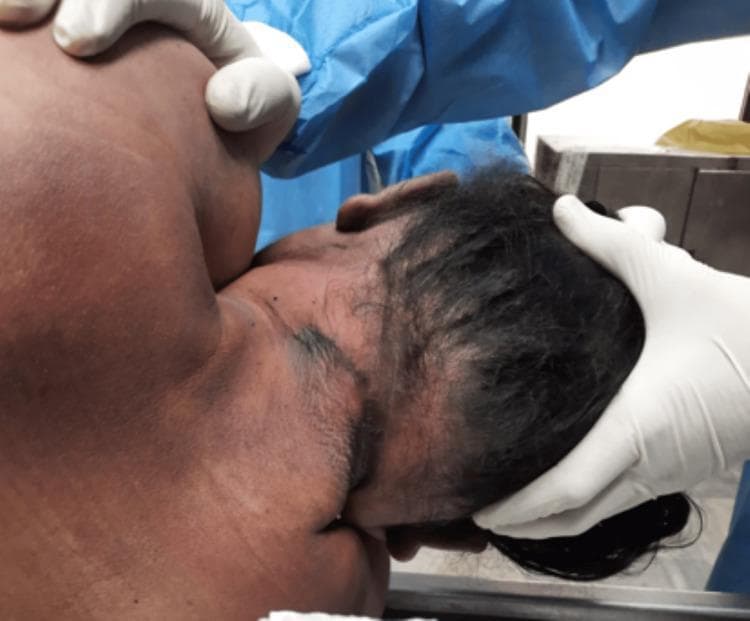 This forensic clinical photograph depicts the posterior aspect of the neck and head of a deceased individual during a medicolegal autopsy. The primary finding is a prominent, broad ligature mark located high on the neck, above the level of the thyroid cartilage. The mark is characterized by dark, parchment-like skin discoloration and bruising, appearing oblique and discontinuous at the back, which is a classic finding in cases of hanging where the knot creates a gap in the impression. The skin surrounding the furrow remains largely intact without significant laceration. The image illustrates the external signs of mechanical asphyxia, serving as an educational resource for forensic pathology and trauma assessment. Key features include the ligature’s width, its anatomical position relative to the laryngeal structures, and the characteristic lack of complete encirclement.