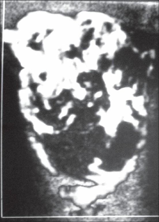This diagnostic image is a Color Doppler ultrasonography scan of the left orbit, demonstrating an extraconal mass lesion. The mass is well-circumscribed and encapsulated, showing a predominantly echogenic texture. In this Color Doppler mode, the lesion displays rich internal vascularity, characterized by multiple tortuous vascular channels distributed throughout the mass. The findings include small, low-flow feeding arteries, which are indicative of a vascular lesion. Clinically, this imaging represents a vascular malformation or hemangioma situated in the superomedial quadrant of the orbit, which causes lateral displacement of the medial rectus muscle and inferolateral displacement of the globe. The appearance is used to teach ultrasound characteristics of orbital tumors, focusing on echogenicity, encapsulation, and Doppler flow patterns in soft tissue masses.
