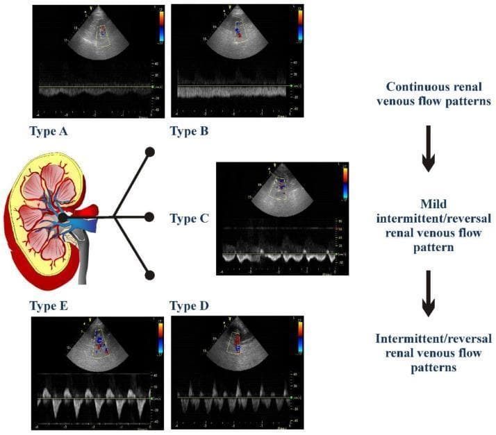 This diagnostic comparison chart illustrates five distinct renal venous Doppler flow patterns (Type A to Type E) used to assess renal congestion and cardiovascular health. The central anatomical diagram of a kidney highlights the segmental and interlobar veins where pulsed-wave Doppler measurements are obtained. The patterns are categorized into three clinical groups: 1) Continuous renal venous flow (Types A and B), which show biphasic or nearly constant forward flow; 2) Mild intermittent/reversal flow (Type C), characterized by short telediastolic interruptions or brief reversal waves; and 3) Intermittent/reversal flow patterns (Types D and E), which demonstrate progressive severity from biphasic interruptions to a monophasic intermittent pattern with prominent reversal waves. Each type includes a color Doppler ultrasound view of the kidney and a corresponding spectral Doppler waveform, mapping the transition from normal venous return to significant pulsatility and flow reversal associated with right-sided heart failure and elevated central venous pressure.