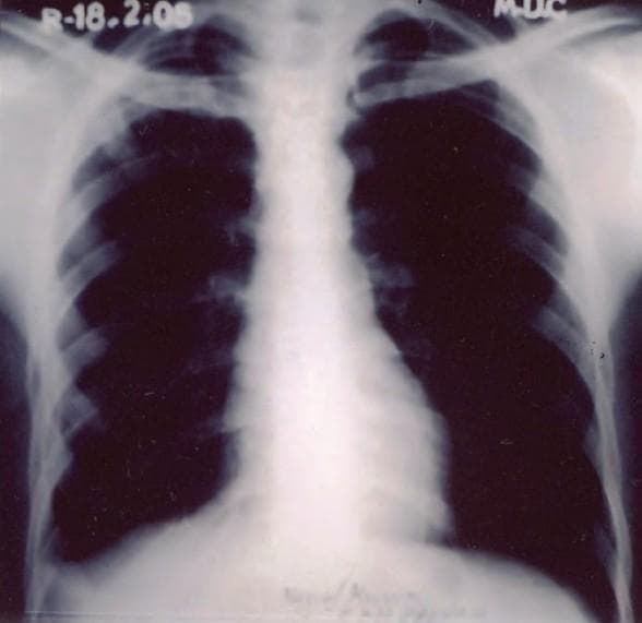 Posteroanterior (PA) view chest X-ray of a 24-year-old male, representing a follow-up assessment at 4 months post-treatment for pulmonary tuberculosis and bilateral pleural effusion. The diagnostic image shows significant resolution of previous pathology. The left lung field demonstrates clearing of the pleural space with a sharp costophrenic angle and normal aeration. In contrast, the right costophrenic angle remains blunted, a finding consistent with residual pleural thickening rather than active effusion. A subtle, resolving heterogeneous opacity is noted in the right upper zone, corresponding to the site of prior infection. The mediastinal contour and cardiac silhouette appear within normal limits. This image serves as a clinical example of radiological progression and sequelae following successful anti-tubercular therapy (ATT) in a case of sequential bilateral tuberculous pleurisy.